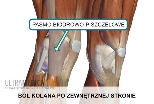 Ból kolana po zewnętrznej stronie - ITBS